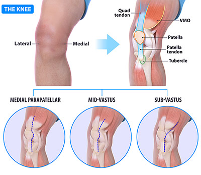 Knee incisions Fig