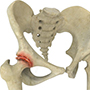 Hip Arthritis