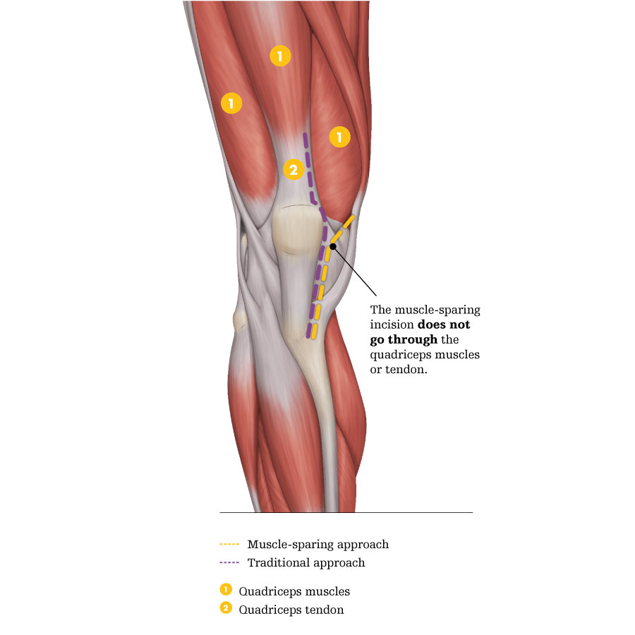 Diagram of the knee comparing the muscle-sparing incision, which does not go through the quadriceps muscles or tendon, with the traditional incision.