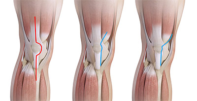 Knee incisions Fig