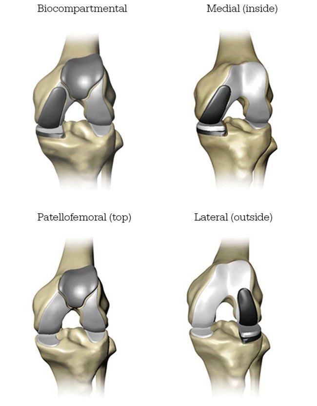 Mako Robotic-Arm Assisted Technology for partial knee replacement