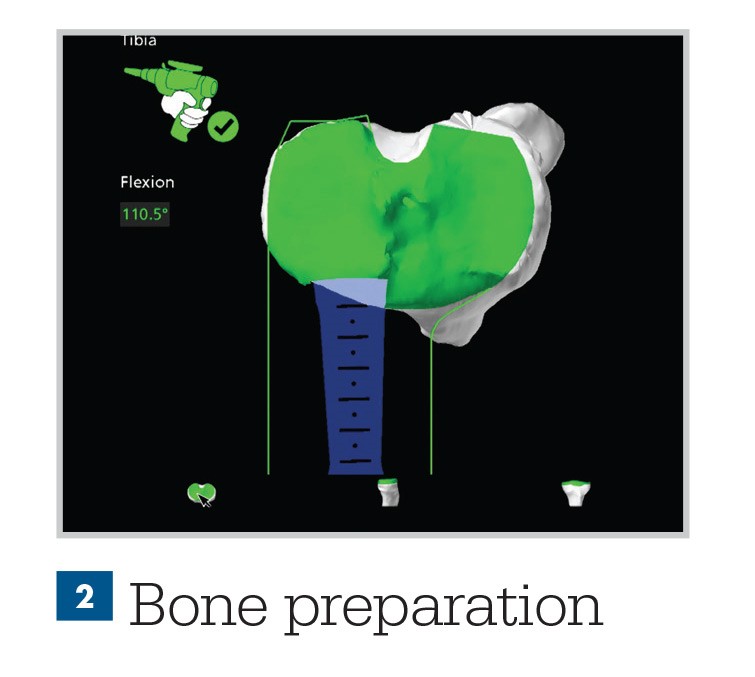 Mako Robotic-Arm Assisted Technology for total knee replacement