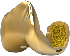Metal Allergy and Joint Replacement Image 1